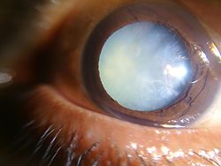 Cataract